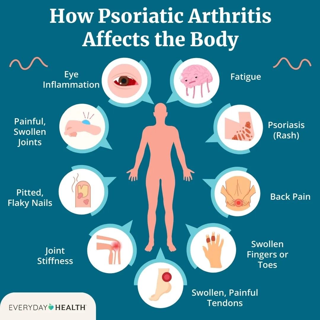 How Psoriatic Arthritis Affects the Body: Fatigue, psoriasis (rash), back pain, swollen fingers or toes, swollen painful tendons, joint stiffness, pitted flaky nails, painful swollen joints, eye inflammation