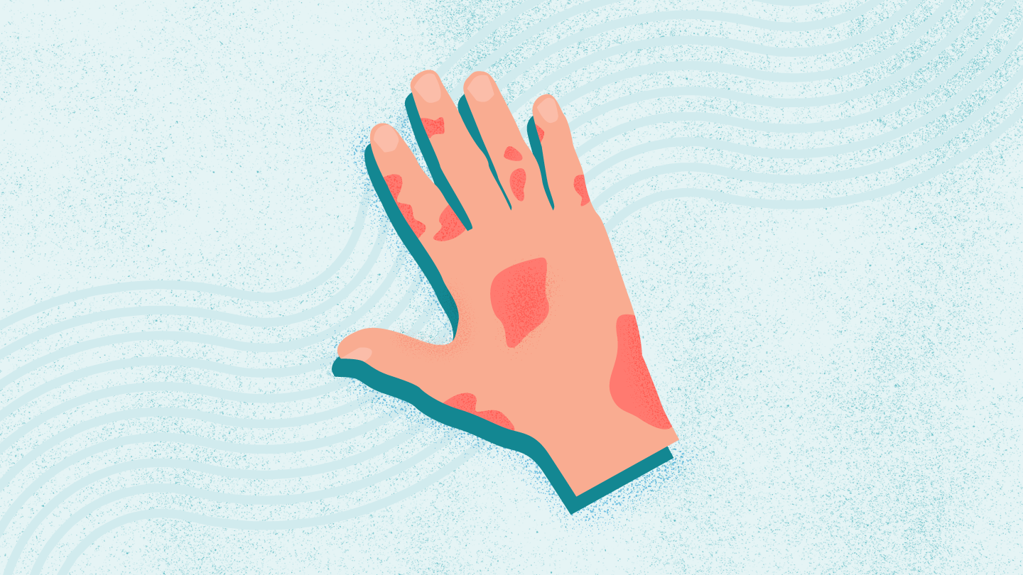 What Is Psoriatic Arthritis? Symptoms, Causes, Diagnosis, Treatment, and Prevention