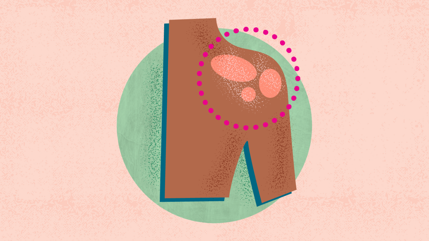 What Is Psoriasis? Symptoms, Causes, Diagnosis, Treatment, and Prevention