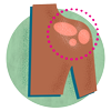 Psoriasis